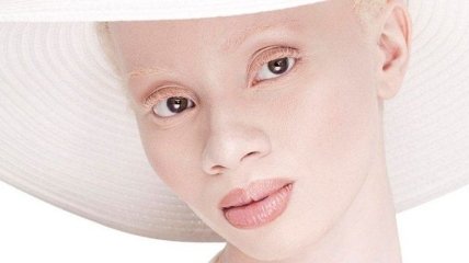 Альбиносы Люди Фото
